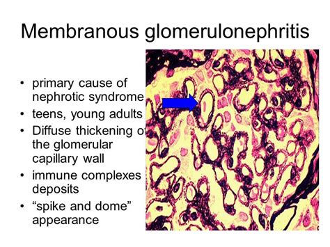 spike and dome appearance membranous nephropathy|Membranous nephropathy: Clearer pathology and mechanisms .